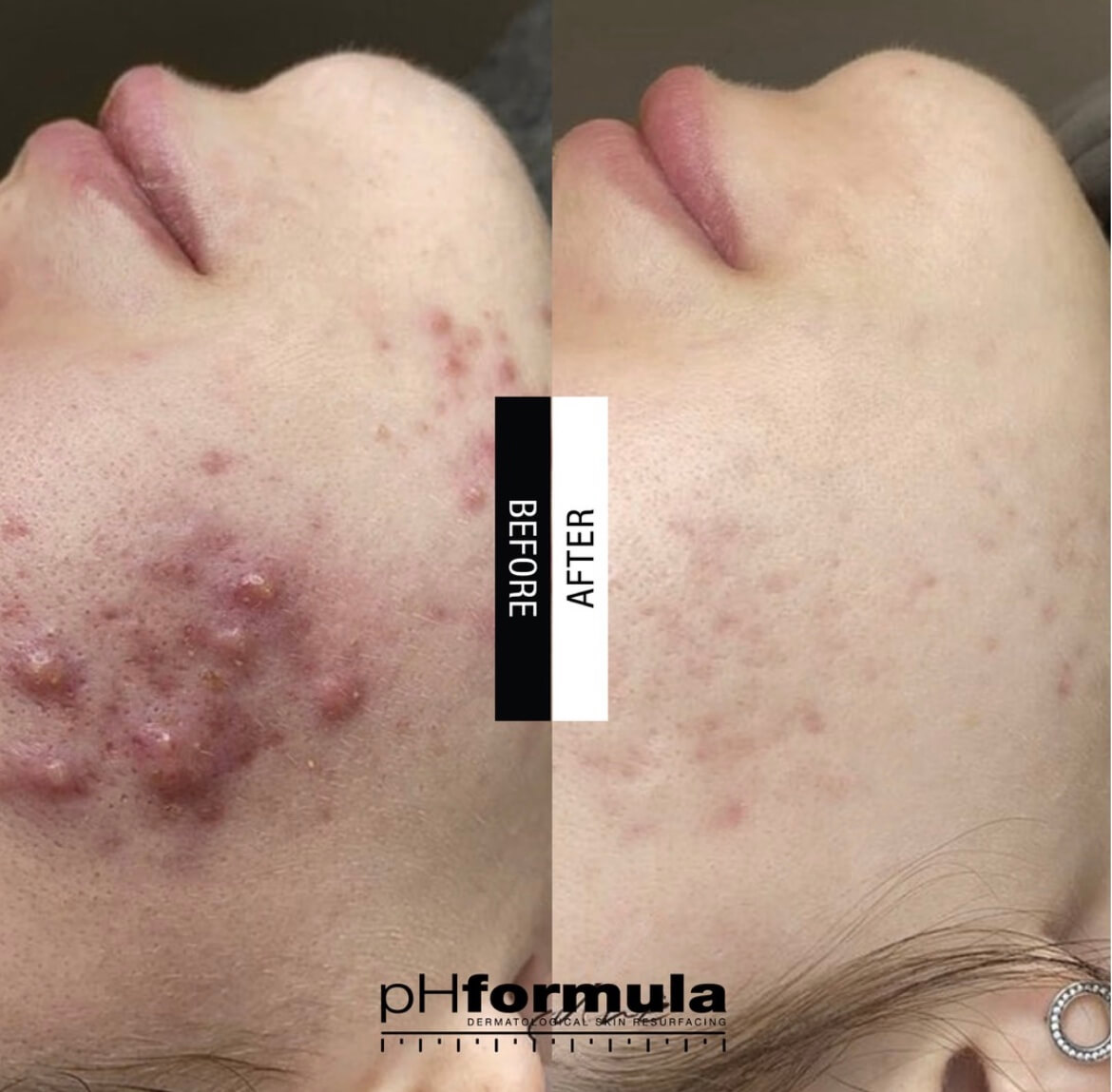 Cosmelan Peel Before After Results