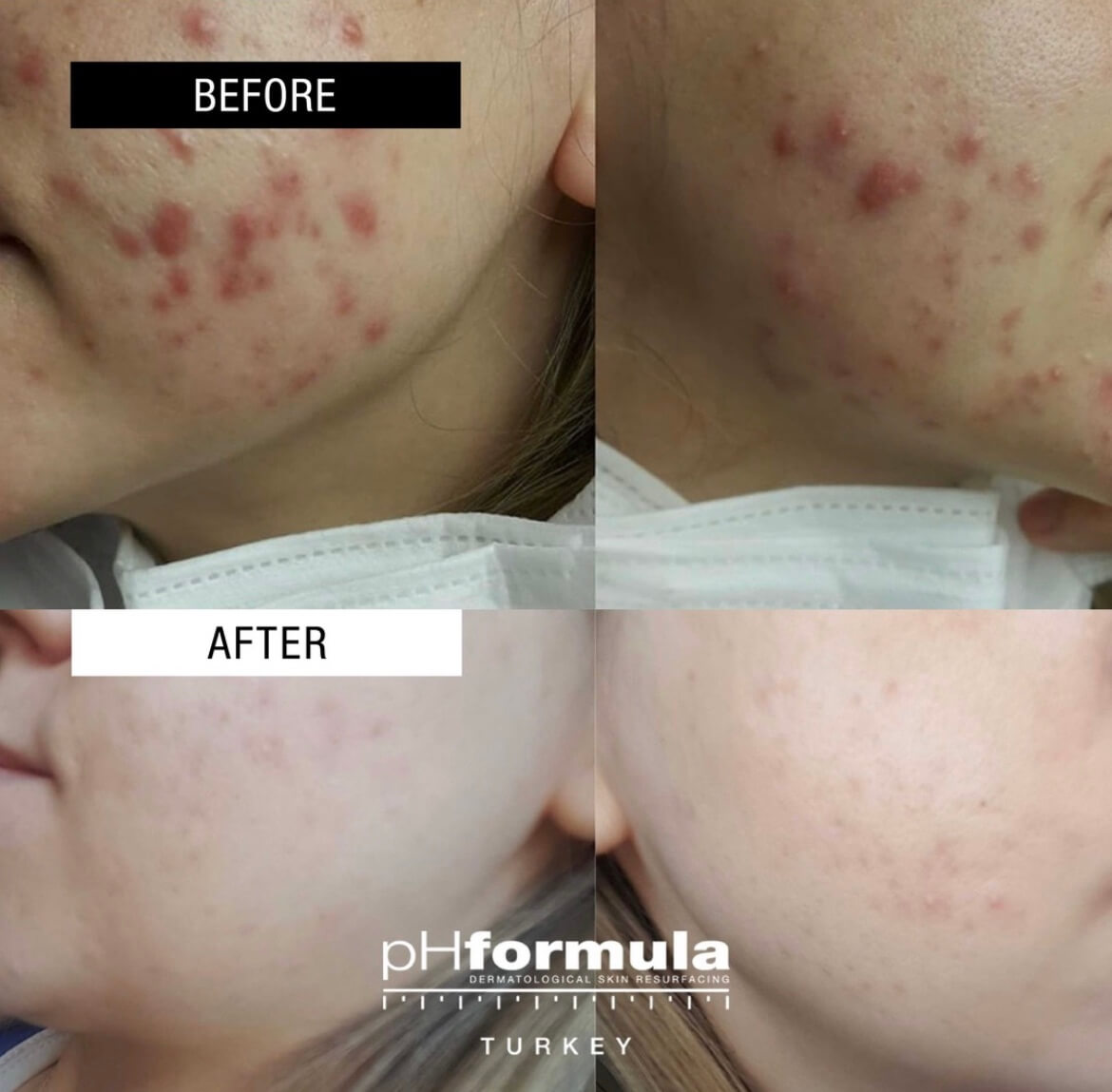 Cosmelan Peel Before After Results