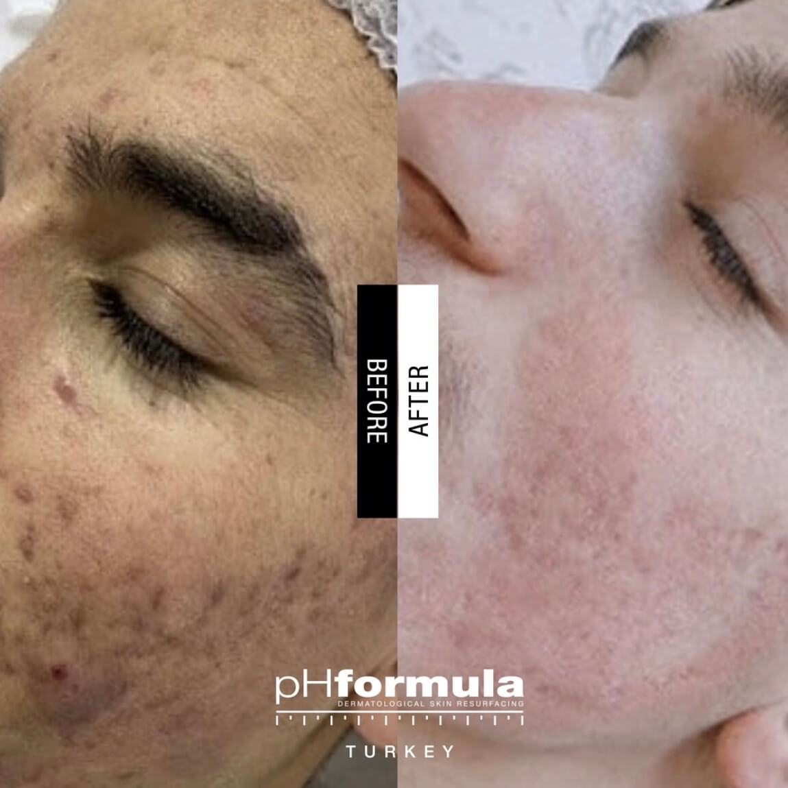 Cosmelan Peel Before After Results