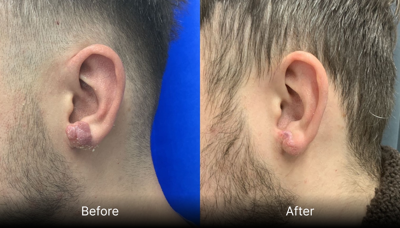 Keloid Excision