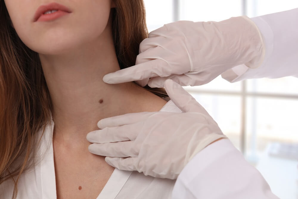 Cosmetic mole removal Derby