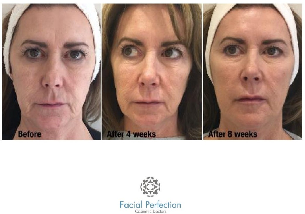 non-surgical facelift Derby