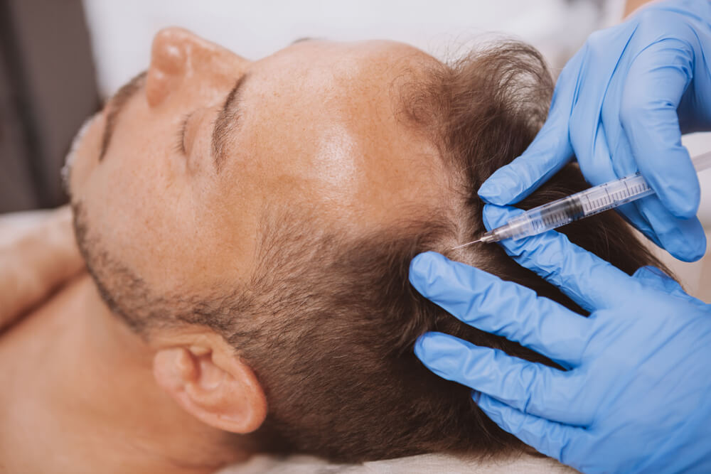 PRP for Hair loss